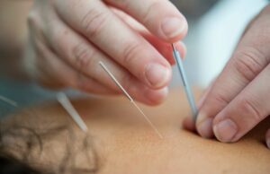 acupuncture needles inserted